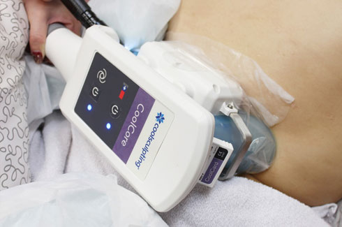 aplicação de coolsculpting nos flancos para redução da gordura localizada com criolipólise